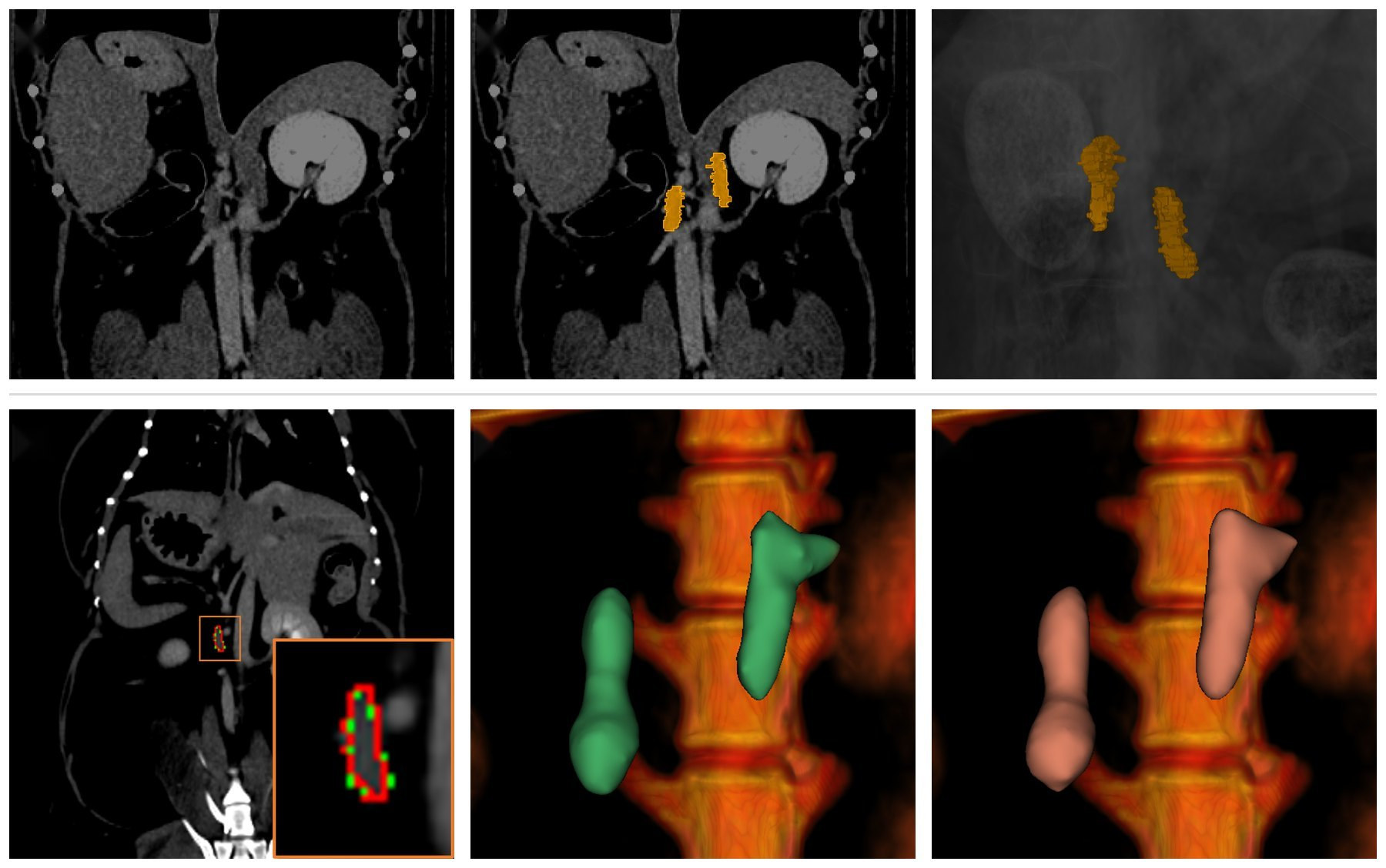 Manually annotated adrenal glands (top) train a Swin-UNETR 3D segmentation model → prediction (red) vs. ground truth (green) with 3D volumes, DSC 0.885 / ICC 0.957 · Pakistan Veterinary Journal, 2025 (JCR top 2%)