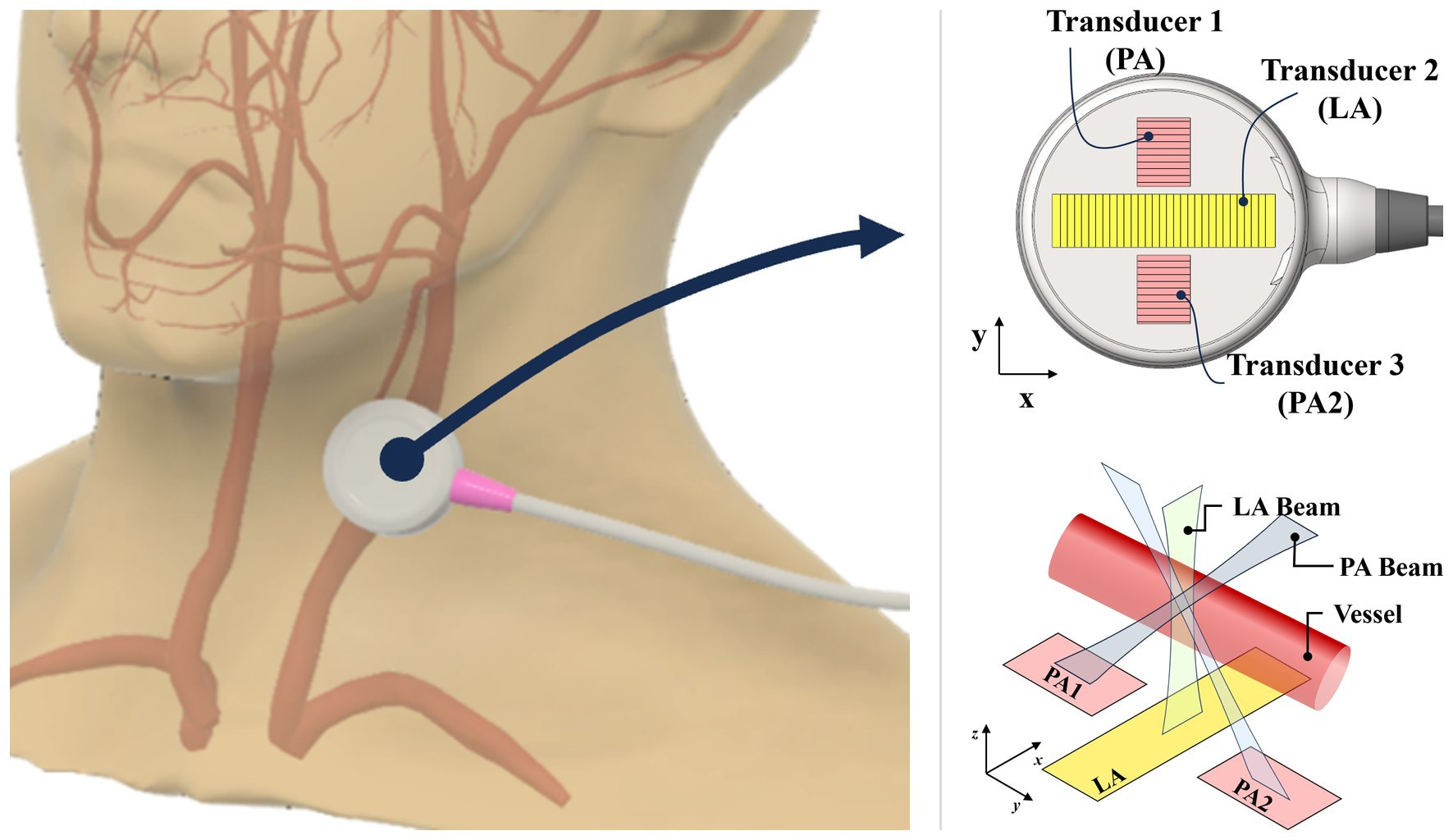 Wearable cross-shaped ultrasound array worn on the neck → a linear array plus two orthogonal phased arrays whose crossed beams enable angle-independent vector Doppler flow monitoring · IEEE TIM, 2026 (JCR top 5.6%)